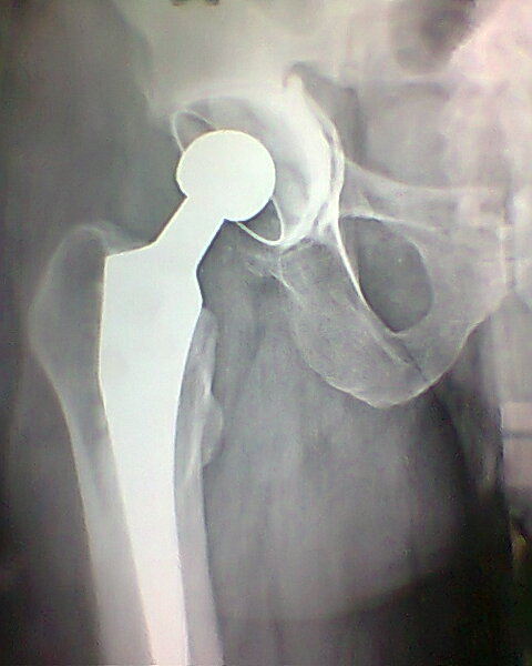 Cemented Hip Replacement in Meerut Image 2