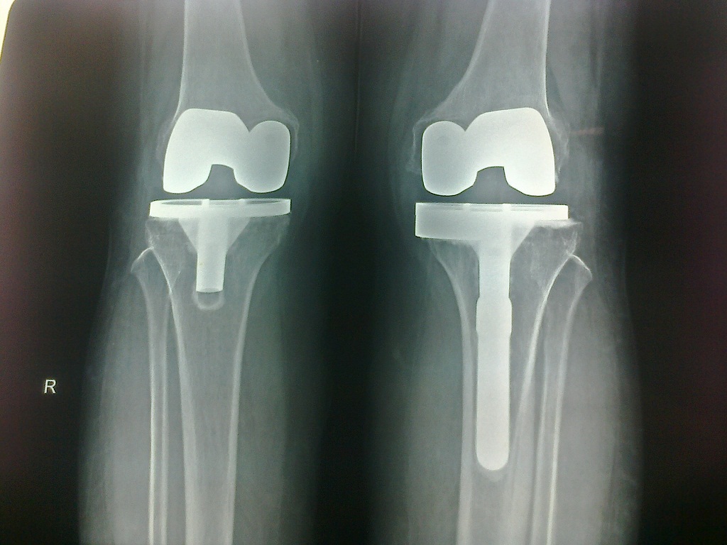 Total Knee Replacement in Meerut Image 5
